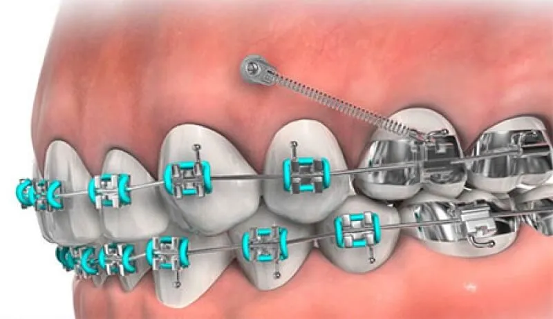 Dental Implants Plantation, Orthodontic Implants