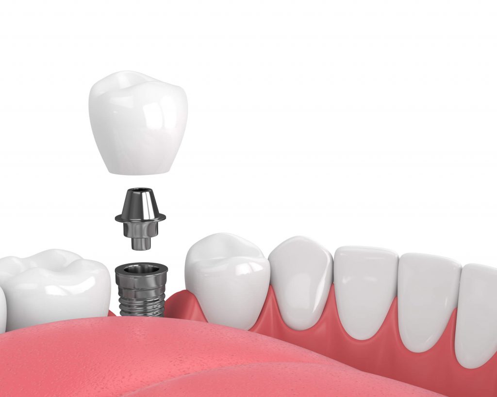 How to find Dental Implants Miramar?