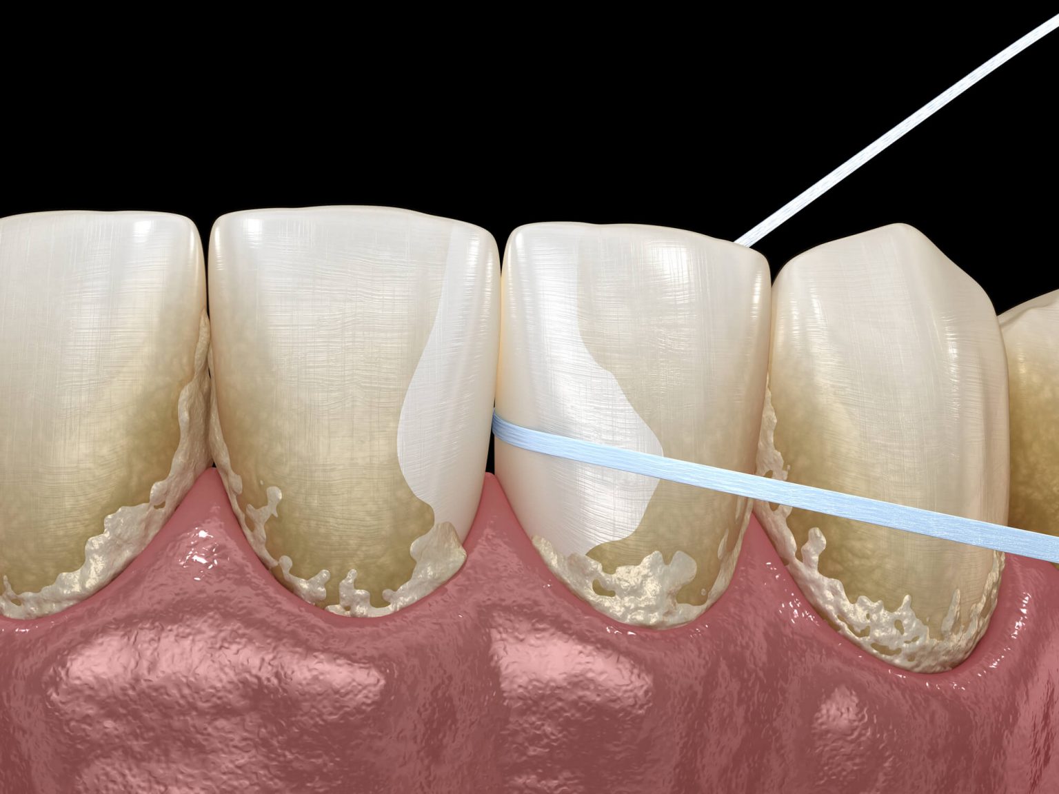 What is Dental Calculus? Dr. M Center