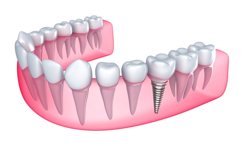 diagram best dental implants davie