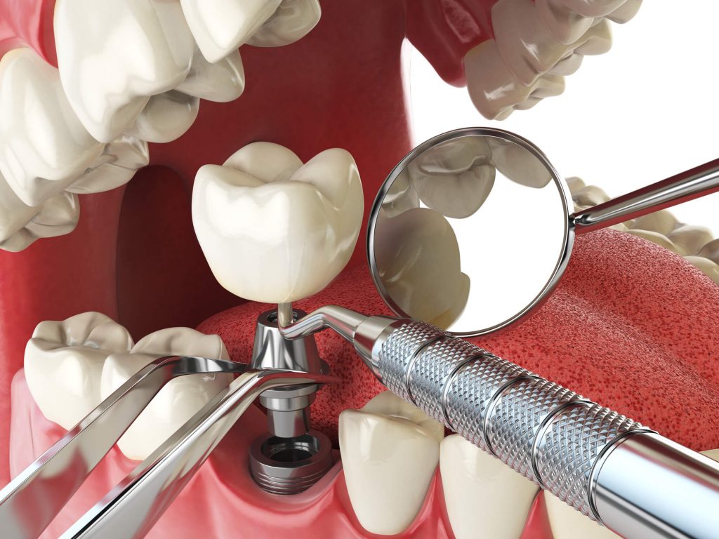 Dental implants Periodontist in plantation