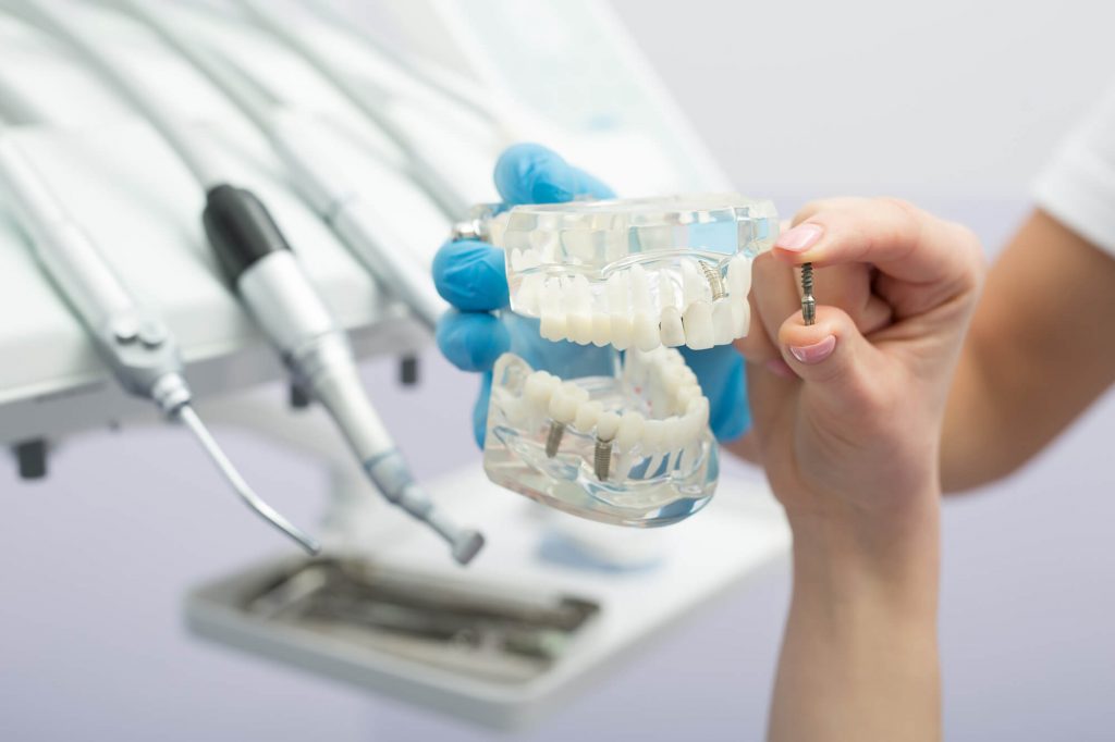 A Case of Dental implants in davie 