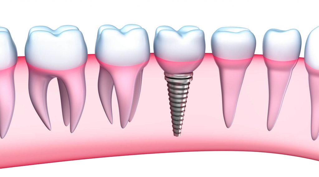 illustration-of-dental-implant