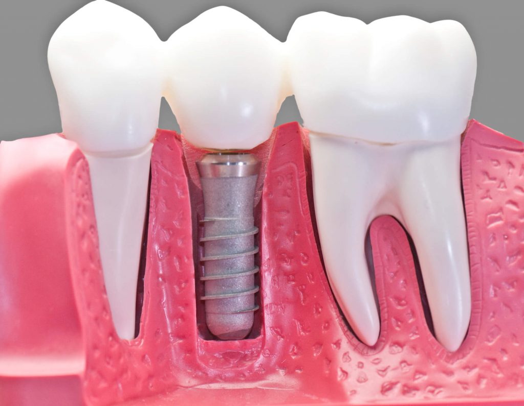 Dental implants Miramar