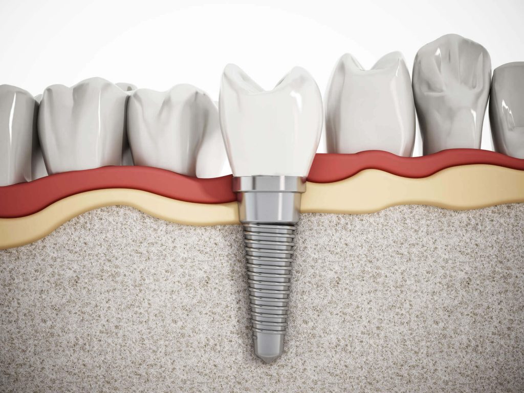 a close up of one of the dental implants in sunrise 