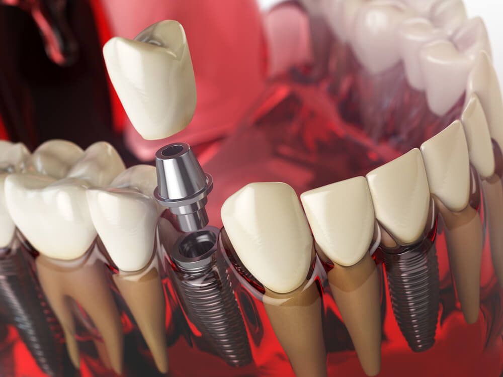 A closer look at the best dental implants in Davie