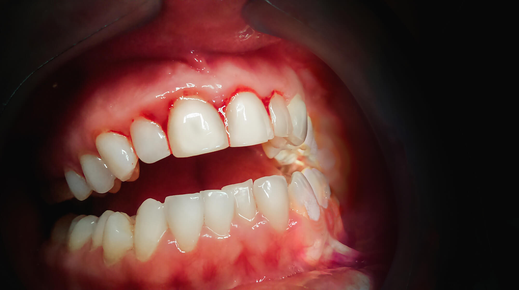 a patient with bleeding gums at the office of an expert in Sunrise periodontics