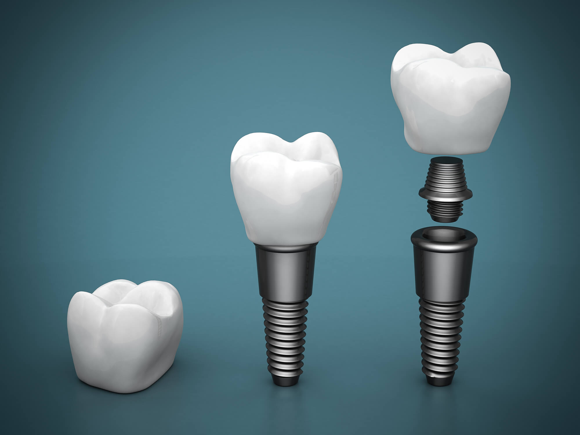 Dental implants in Weston
