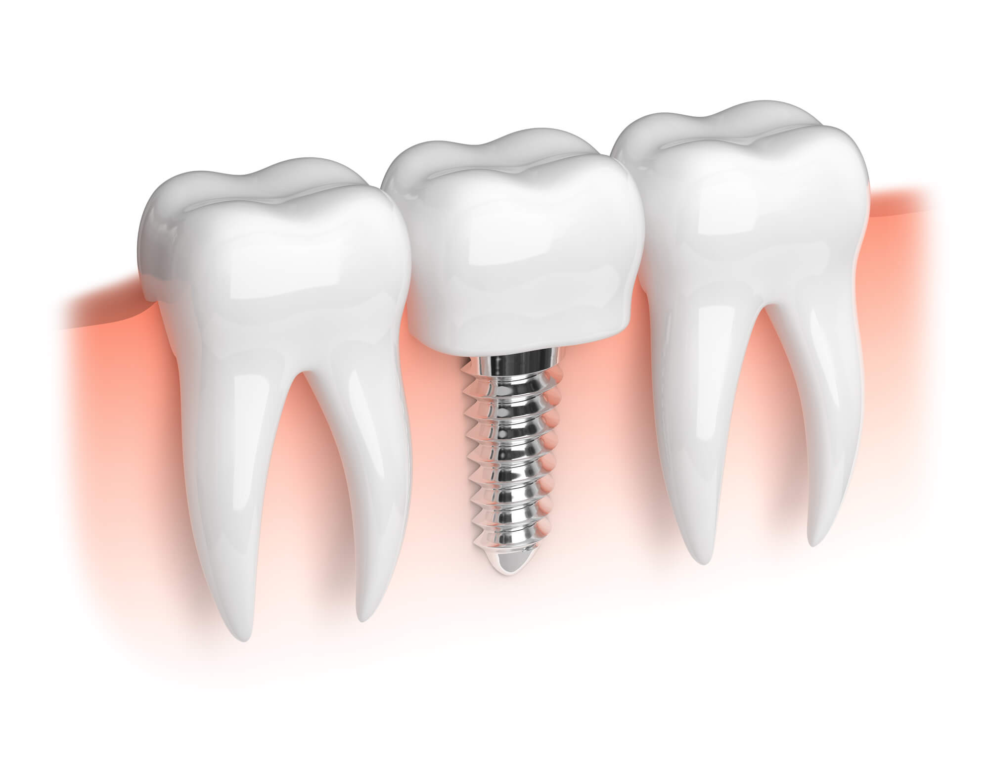illustration of dental implants in Davie in between teeth