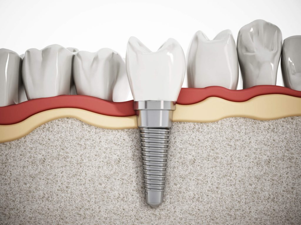 illustration of dental implants in Weston