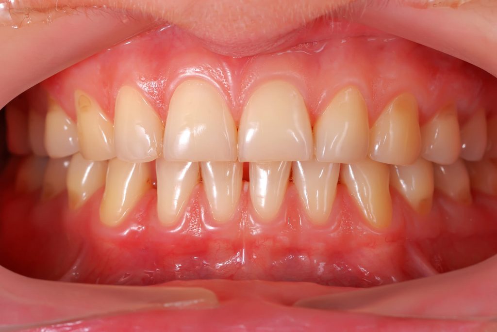 healthy gums because of Sunrise periodontics