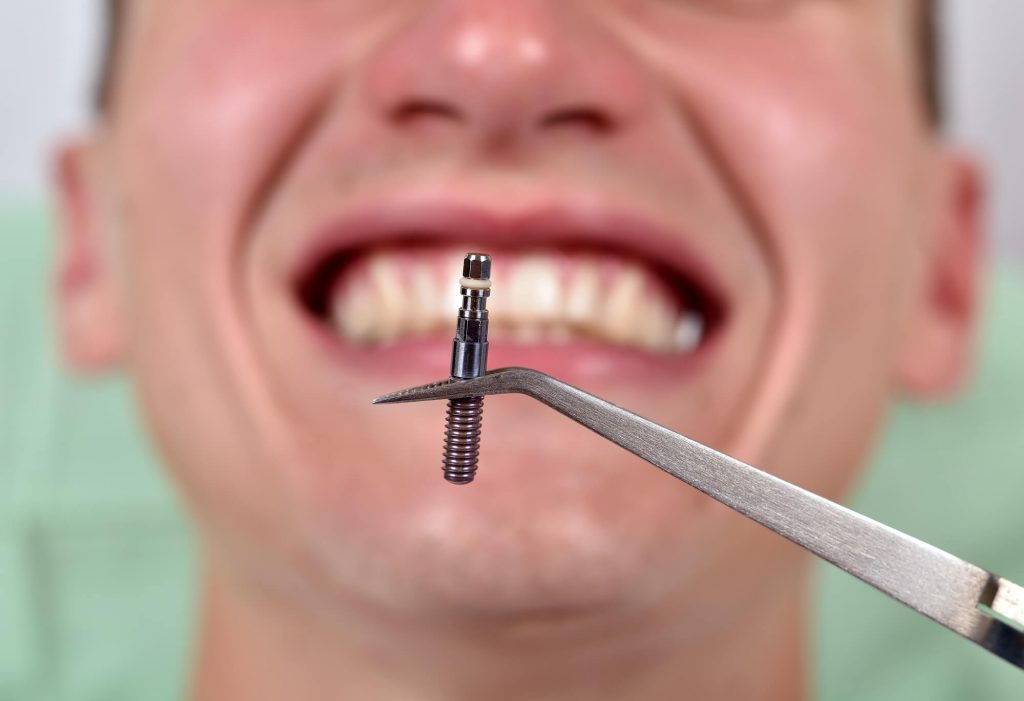 a dentist discussing Dental implants in Weston 