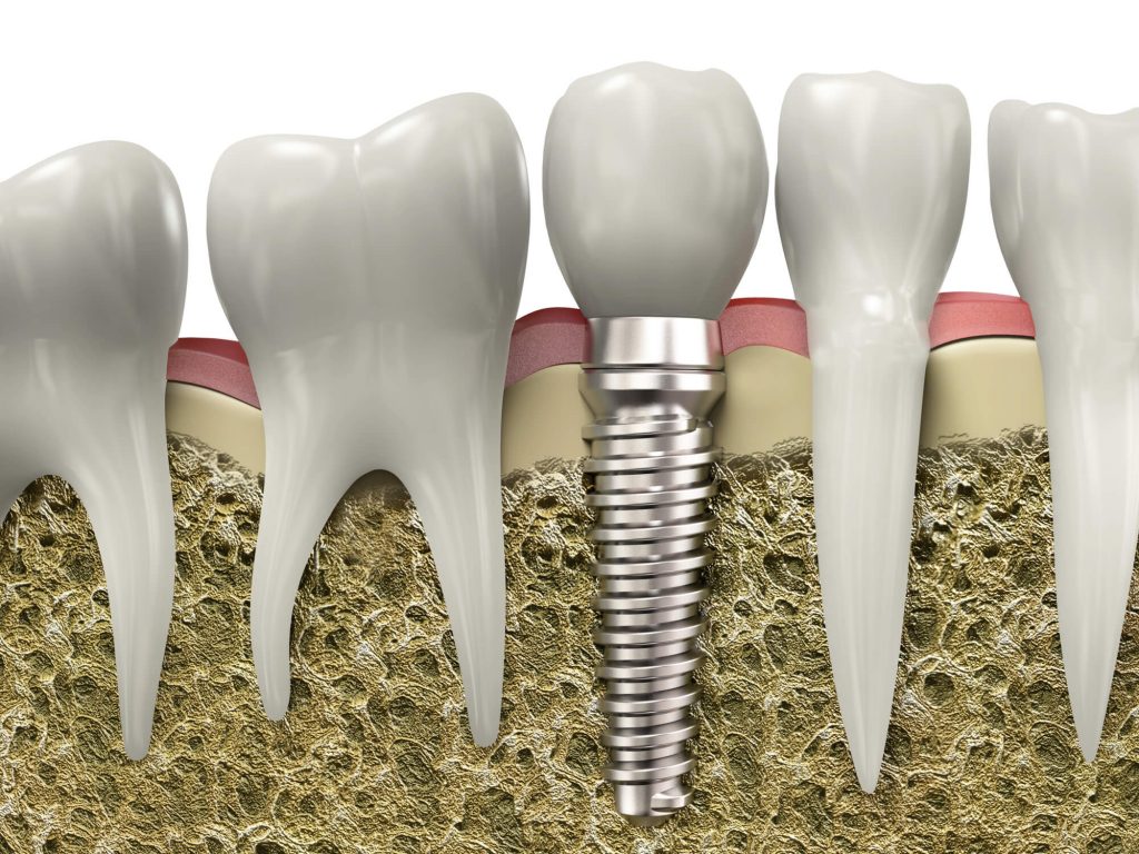 Illustration Dental implants in Davie