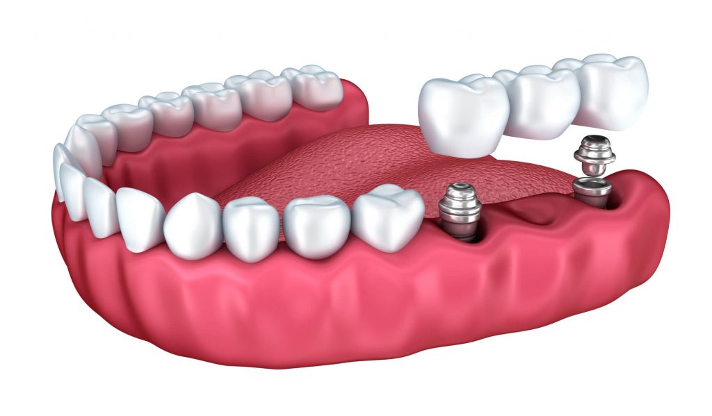 Illustration of dental implants in Davie being placed