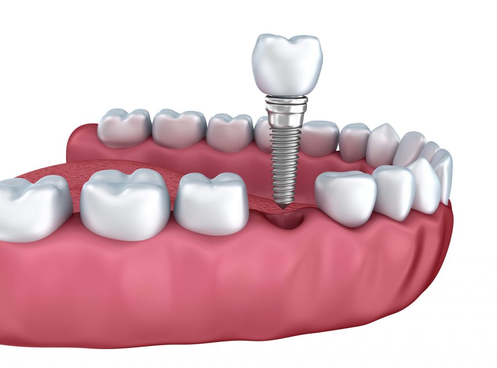 Illustration of the best dental implant in Davie placed on the lower teeth